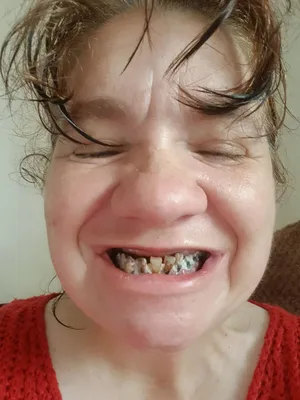 Когда крошатся зубы